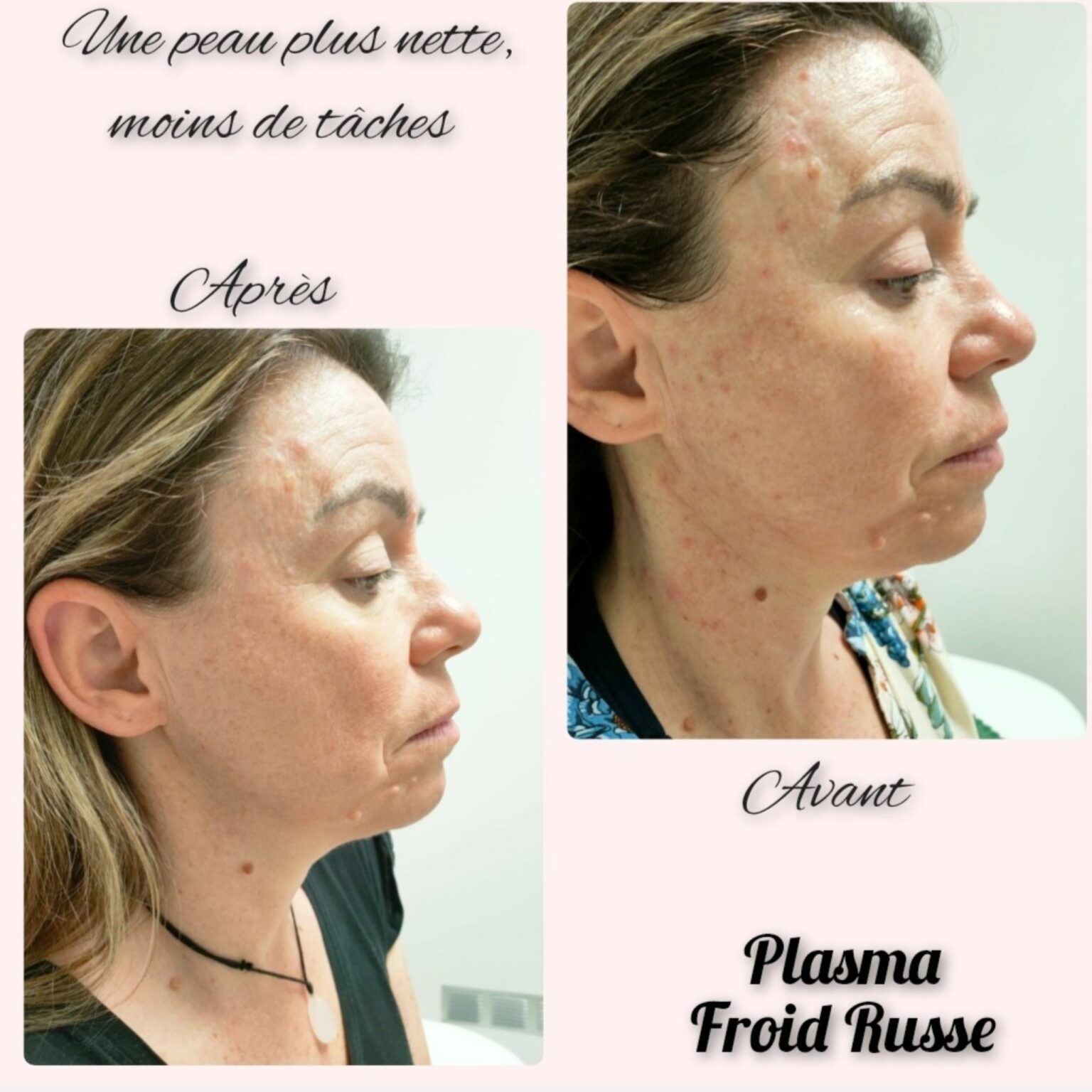 plasma nataha beauté 1